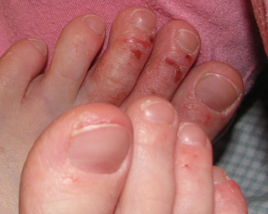 Eczema and Dishydrosis on Toes
