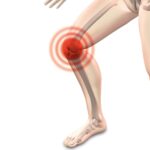 arthrocalman osteoarthritis knee 2384253